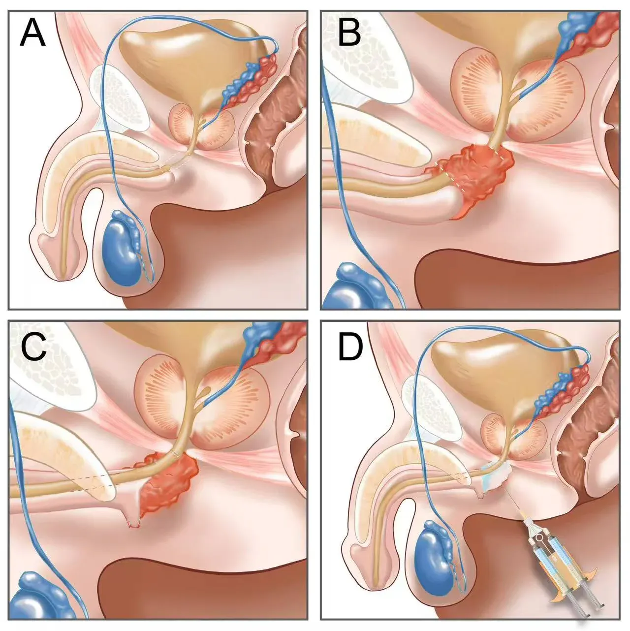 Four-part clinical illustration showing anatomy and stages in a urological procedure